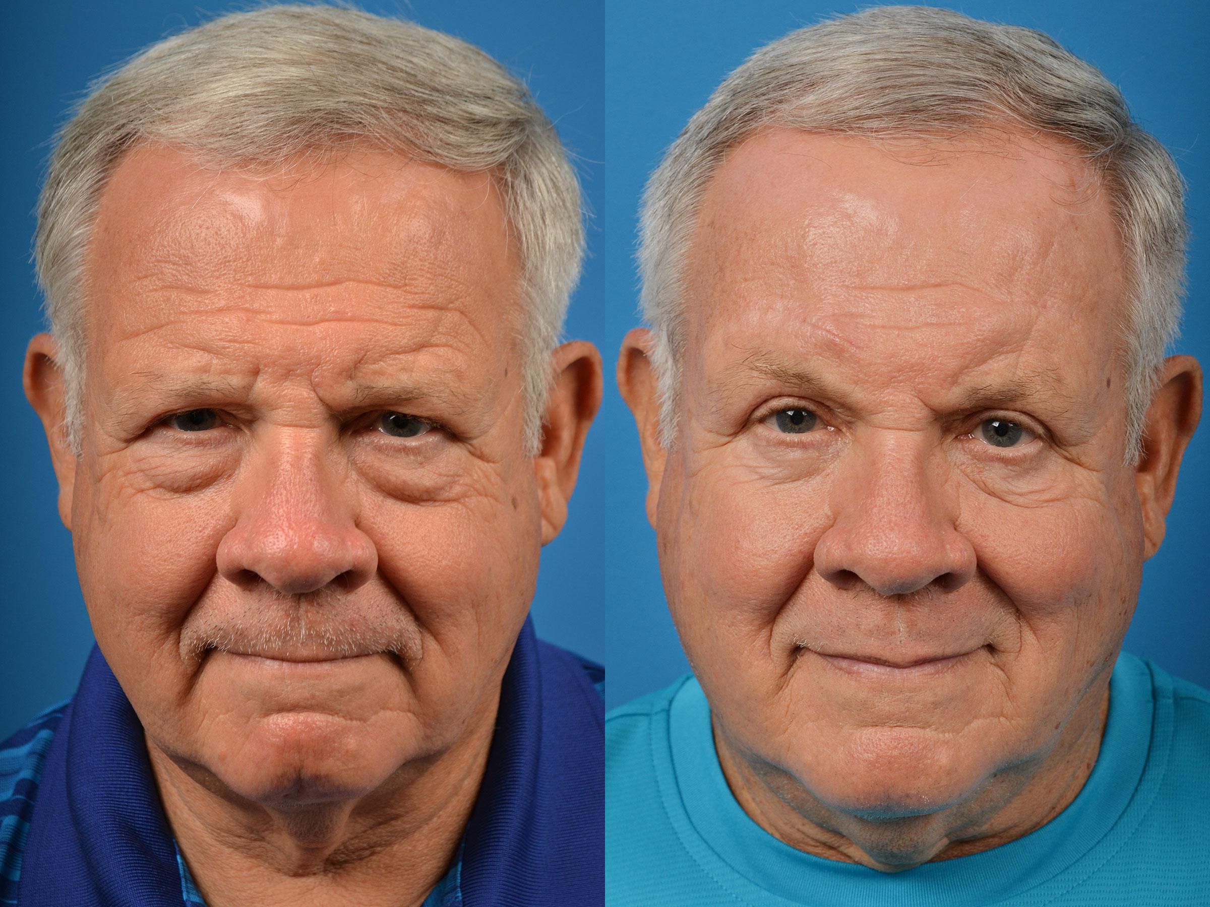 Brow Lift Photos Melbourne, FL Patient 55370